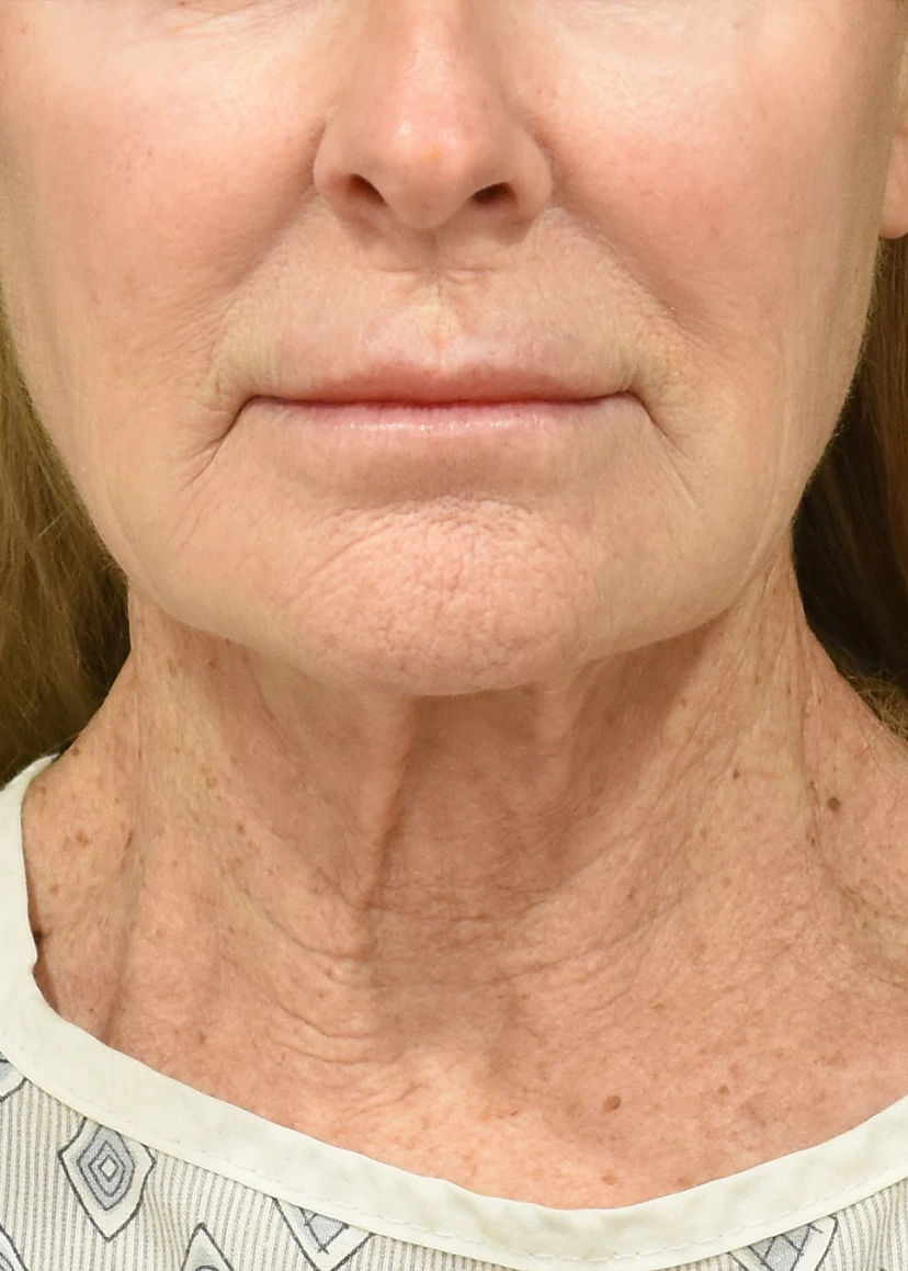 Neck Lift Patient 20 Set 1 Before