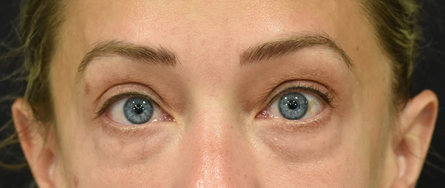 Eyelid Surgery Patient 24 Set 1 Before