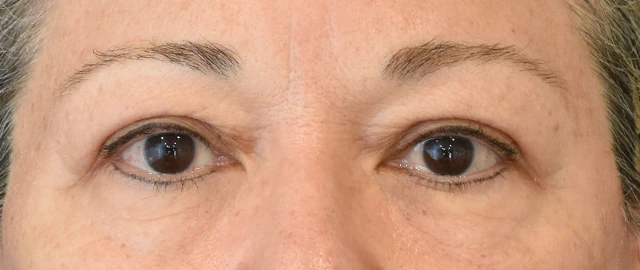 Eyelid Surgery Patient 20 Set 1 After