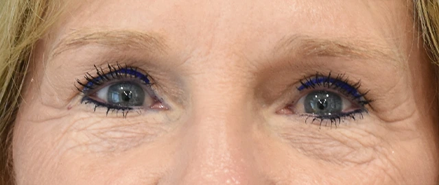 Eyelid Surgery Patient 25 Set 1 After