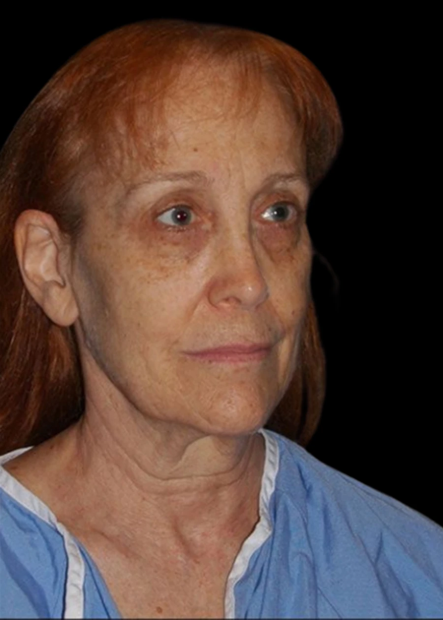Extended Deep Plane Facelift Patient 7 Set 1 Before