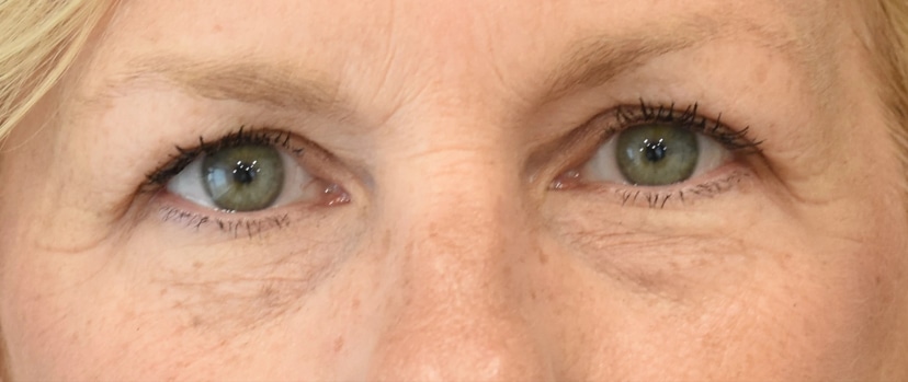 Eyelid Surgery Patient 10 Set 1 After